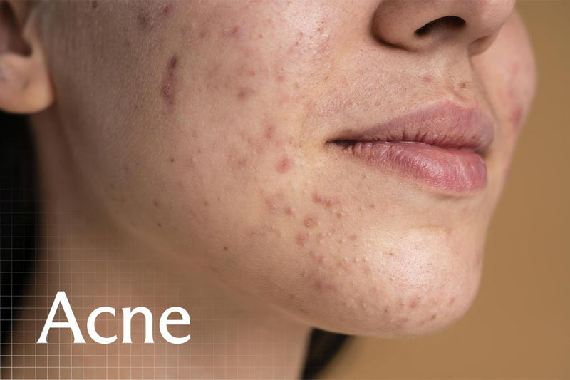 acne skincare advice